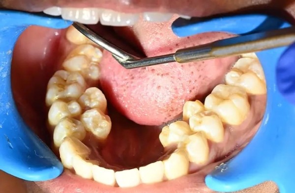 У девушки из Индии рекордное число зубов